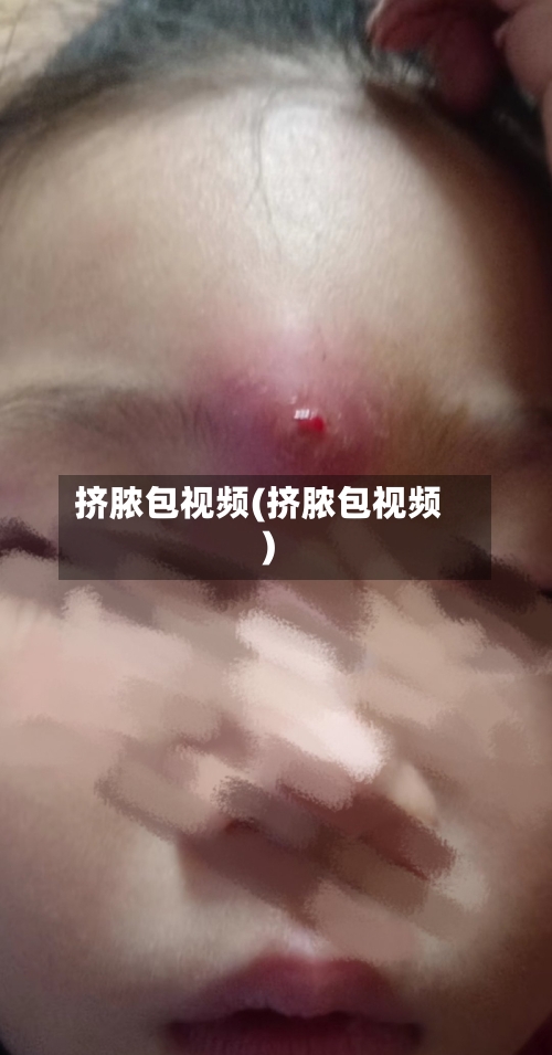 挤脓包视频(挤脓包视频)-第2张图片